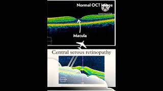 Normal oct vs Abnormal oct retina shortvideo viral knowledgewithani [upl. by Lady]