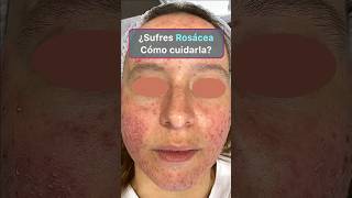 Los 4 mejores tratamientos de la rosácea rosacea rosaceaskincare [upl. by Zetroc91]