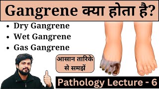 Gangrene  Types of Gangrene  Gas Dry amp Wet  Treatment  Pathology Lecture in Hindi [upl. by Dodie]