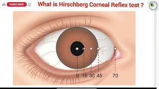 How to perform a hirschberg test  Hirschberg test explained  Interpretation of hirschberg test [upl. by Manella726]