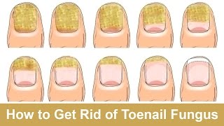 How to Get Rid of Toenail Fungus Fast and Naturally [upl. by Palgrave]