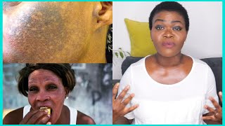 HOW TO REPAIR DAMAGED BLEACHED SKIN  What To Use After Skin Bleaching To Make Your Skin Glow [upl. by Gratiana]