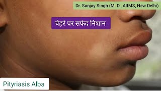 Pityriasis Alba चेहरे पर सफेद दाग Pityriasis PityriasisAlba vitiligo vitiligocure whitespots [upl. by Aisak]