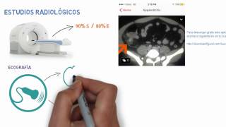 Apendicitis Parte 2 de 2  Diagnóstico de apendicitis  criterios de alvarado [upl. by Atniuqal]