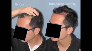 Hairline Hair Transplant Result using 1236 Grafts from Shapiro Medical Group [upl. by Annahsohs912]