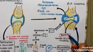 Rheumatoid arthritis aetiology pathophysiology symptoms and treatment in hindi [upl. by Aralk]