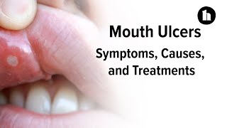 Mouth Ulcers Symptoms Diagnosis and Treatments  Healthline [upl. by Brion]