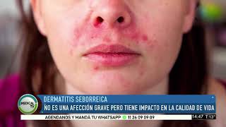 MEDICAL TV Dermatitis Seborreica [upl. by Odrahcir]