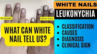 White Nails Leukonychia  Classification Causes Diagnosis  Nail Changes in Systemic Diseases [upl. by Onivla363]