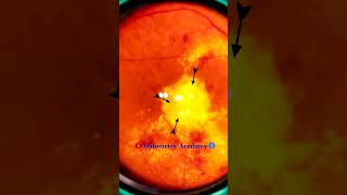 Diabetic retinopathy  Hemorrhages  Hard exudates  Fundus  Short Video 191 [upl. by Siladnerb]