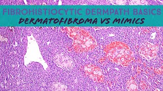 Fibrohistiocytic Dermpath Basics  dermatofibroma amp mimics dermatology dermatopathology pathology [upl. by Caren]