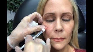 Dermal Filler Under Eyes Tear Trough Restylane and Radiesse [upl. by Gussy465]