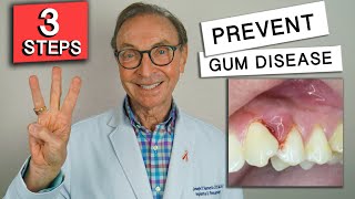 3 Easy Ways to Prevent Gum Disease at Home [upl. by Theurer]