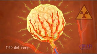 Liver Tumor Radioembolization [upl. by Jed]