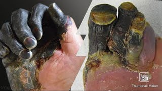 Gangrene and its types dry gangrene wet gangrene gas gangrene mci fmge neetpg [upl. by Kareem]