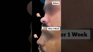 Rhinoplasty Surgery Result After 1 Week  Nose Job Transformation [upl. by Harding]