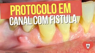 ENDODONTIA PAREI DE ERRAR EM CASO DE FÍSTULA  Endolovers [upl. by Zorine541]