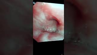 Endobronchial lung mass biopsy [upl. by Enaud493]