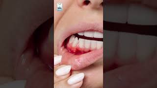 What is mouth ulcers [upl. by Ness]