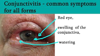 Red or pink eye  Conjunctivitis symptoms and treatment [upl. by Adnirolc]