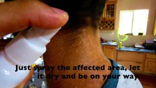 Natural Tinea Versicolor RemedyHaole Rot Spray [upl. by Asila]