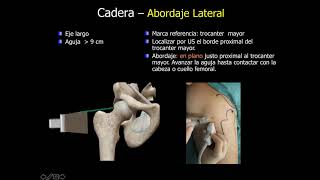 infiltración ecoguiada en la cadera en su cara anterior [upl. by Ydnal]