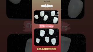 Veneers  Incisal overlap  Cementation  Maxillary Veneers  Smile Designing Maxillary anteriors [upl. by Annahoj]