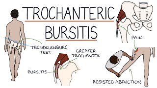 Understanding Trochanteric Bursitis [upl. by Lleze568]