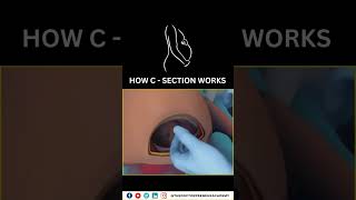 Cesarean Section Explained Why Doctors Choose CSections for a Safer Birth 👶✂️ Cesarean Birth [upl. by Burkley544]