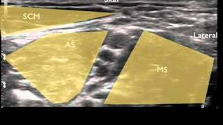 Ultrasound Guided Interscalene Nerve Block [upl. by Eyak70]