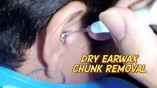 Dry Earwax Chunk Removal [upl. by Libnah]