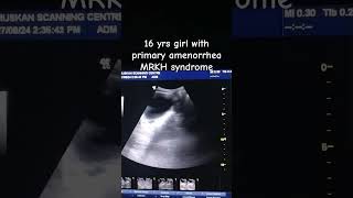 uterineagenesis MRKHsynrome primaryamenorrhea ultrasoundscans menarche [upl. by Nunnery308]