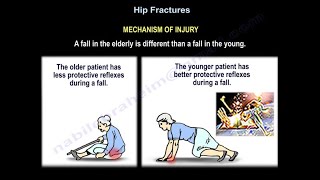 Hip Fractures Mechanism Of Injury  Everything You Need To Know  Dr Nabil Ebraheim [upl. by Origra]