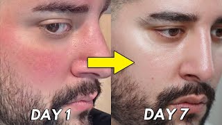 How I healed My Broken Skin Barrier In 7 Days [upl. by Adias20]