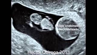 Polipo endometrial decidualizado en un embarazo de 7 semanas y 5 dias [upl. by Muirhead]