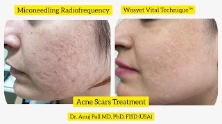 Acne scars treatment with Microneedling Radiofrequency  Subcision  Wosyet Vital Technique™ [upl. by Critchfield172]