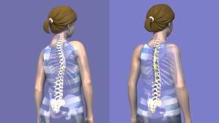 What is Scoliosis surgery [upl. by Iatnohs811]