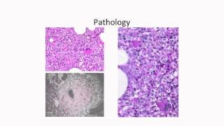 Molecular Profiling of Myelodysplastic Syndromes [upl. by Ariahaj]