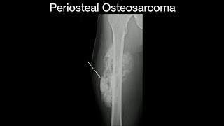 Periosteal Osteosarcoma [upl. by Oramlub333]