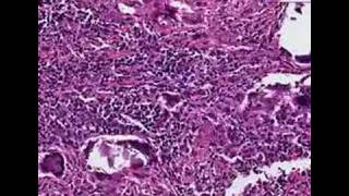 Histopathology Temporal artery Temporal arteritis [upl. by Alexio]