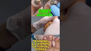 Part 2 Best of Callus Treatments Podiatry  Fungal Nail with Dried Abscess 🦶 Ingrown Nail Treatment [upl. by Aicirpac]