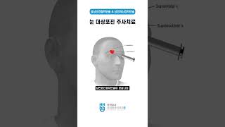 눈 대상포진 주사치료Treatment of herpes zoster ophthalmicus [upl. by Foulk]