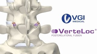 VGI Medical Presents VerteLoc® Posterolateral Fusion [upl. by Qerat520]