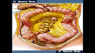 Colon Surgery III DIVERTICULAR Disease of the colon by Dr Mansour M Morsy [upl. by Yonatan197]