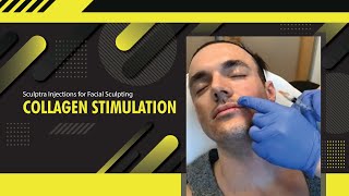 Sculptra Injections for Facial Sculpting  Collagen Stimulation  Dr Jason Emer  LIVE [upl. by Standush]