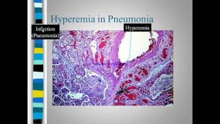 Pathology of congestion Vs Hyperemia [upl. by Letnohc904]