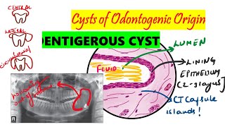 Dentigerous cyst  HISTOPATHOLOGY Clinical  etiopathology DETAILED  Cysts of odontogenic origin [upl. by Yrreb]