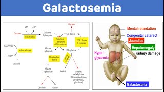 Galactosemia And Galactose Metabolism  Galactosemia Biochemistry [upl. by Ardnaskela204]