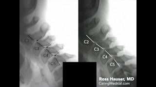 Speech and swallowing difficulty due to cervical spine instability [upl. by Tanney]