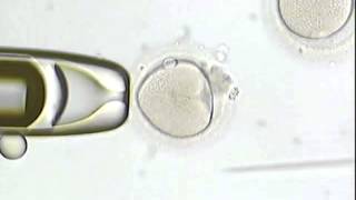 IVF  CHENNAI chennai fertility center DrVMTHOMAS [upl. by Viquelia]